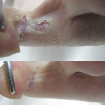 Footlogix Peeling Skin Formula Voet Mousse 125ml